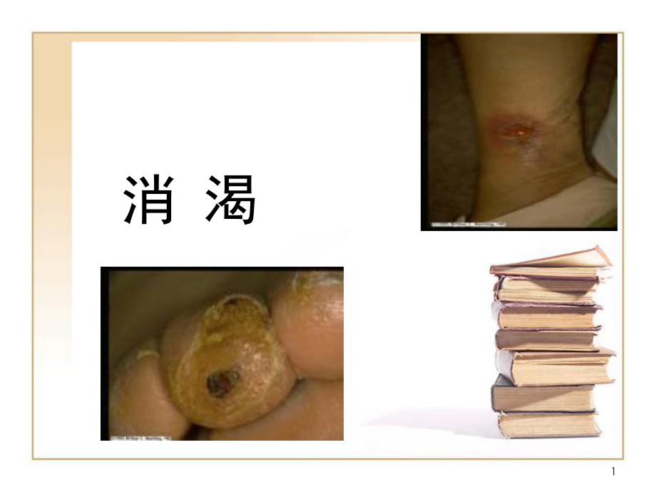 气血津液病证 消渴_第1页