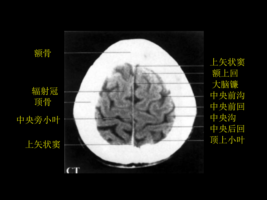 颅脑正常CT和MRI_第1页
