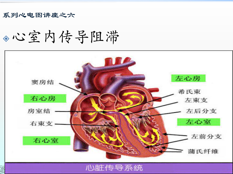 8心室内传导阻滞_第1页