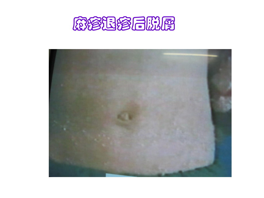 儿科学课件：27 出疹性疾病退疹图片_第1页