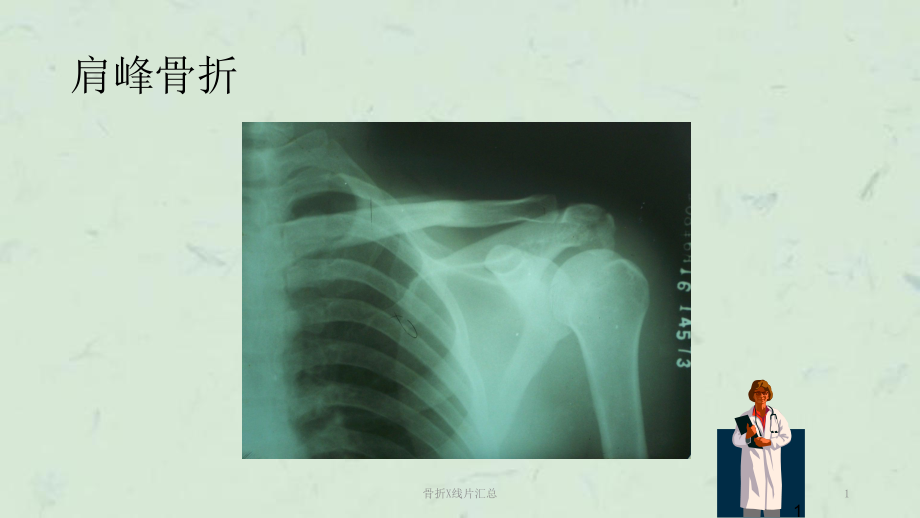 骨折X线片汇总课件_第1页